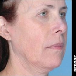 Ultherapy Before & After Patient #1550